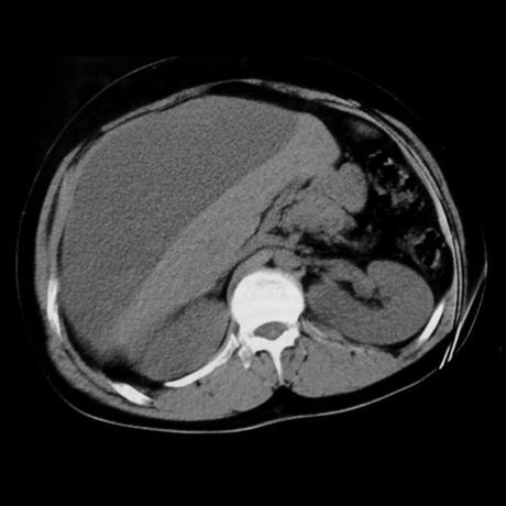 BILIOMA TAC BILIOMA TAC