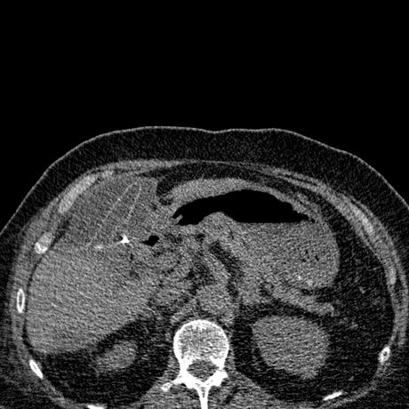 BILIOMA TAC BILIOMA TAC