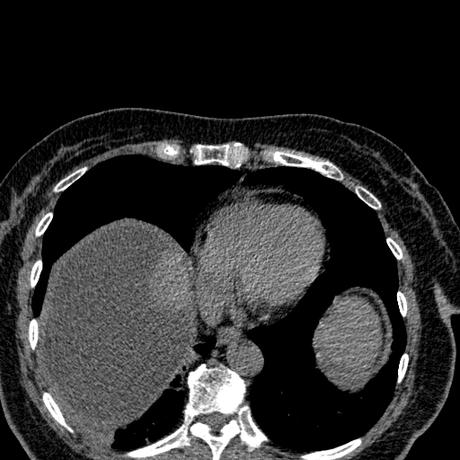 BILIOMA TAC