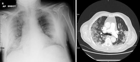Insuficiencia respiratoria y soporte no invasivo en COVID-19 Insuficiencia respiratoria y soporte no invasivo en COVID-19