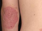 Nuevo Tratamiento Tópico mejora Psoriasis