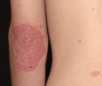 Nuevo Tratamiento Tópico mejora la Psoriasis Nuevo Tratamiento Tópico mejora la Psoriasis
