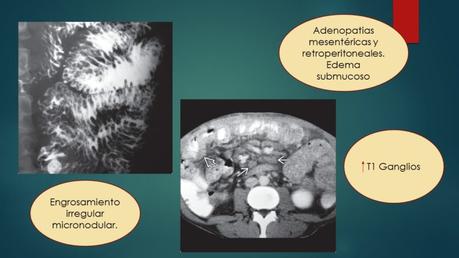 Intestino delgado enfermedades inflamatioras y mala absorcion intestinal