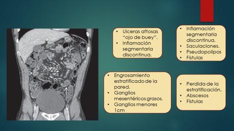 ENFERMEDAD DE CROHN