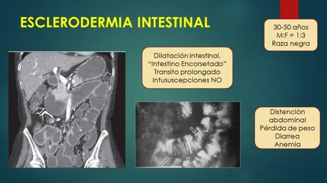 ENFERMEDAD DE CROHN