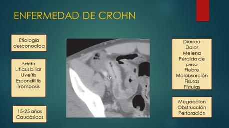 ENFERMEDAD DE CROHN