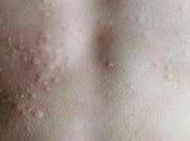 Reacción alérgica contacto