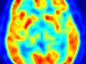 Crean examen detecta Alzheimer años antes primeros síntomas