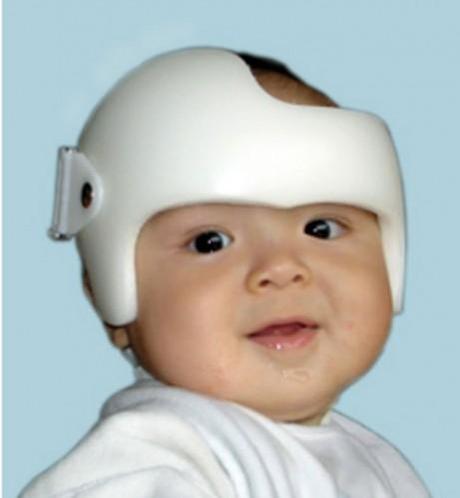 deformidades craneales