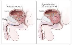 Diagnosticados 18.000 cánceres de próstata en España