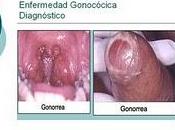 Gonorrea hace resistente Antibioticos