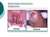 La Gonorrea se hace resistente a los Antibioticos