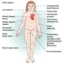 Qué es el Síndrome de Turner