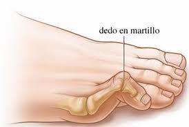 dedomrtillo Qué son los dedos de martillo
