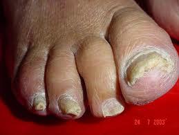 Onicomicosis: la enfermedad de las uñas