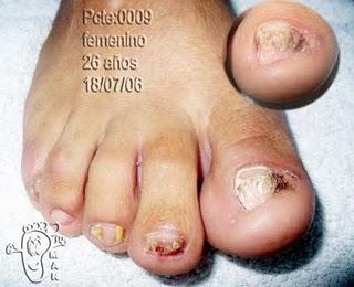 Onicomicosis: la enfermedad de las uñas