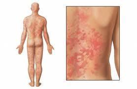 urticarias Tratamientos para la urticaria