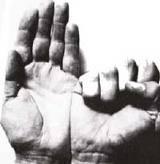 Qué es la dispraxia