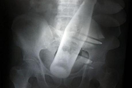 X-Ray: ..Adentro!