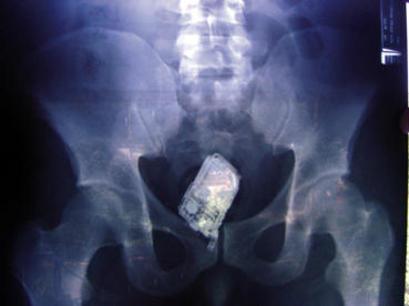 X-Ray: ..Adentro!