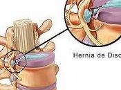 Soluciones quiroprácticas hernias disco