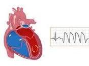 cardiopatía isquémica, primera causa muerte mundo