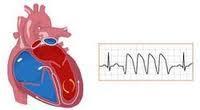 La cardiopatía isquémica, primera causa de muerte en el mundo