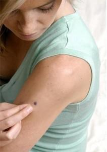 Cuidado Con El Cancer De Piel