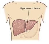 ¿Cuáles son los síntomas de la cirrosis?