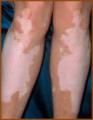 Vitiligo causas y consecuencias de la enfermedad