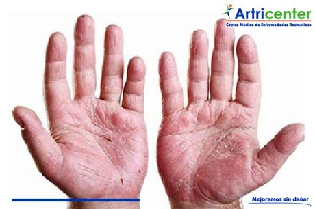 ¿Qué es la artritis psoriasica? ¿Qué es la artritis psoriasica?