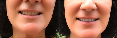 blanqueamiento_dental3 blanqueamiento_dental3