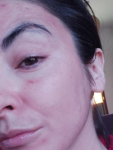 Mi nuevo amigo, el dermapen.