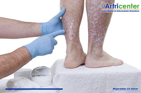 ¿La artritis psoriásica puede afectar otros órganos? ¿La artritis psoriásica puede afectar otros órganos?