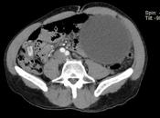 secuela común pancreatitis aguda
