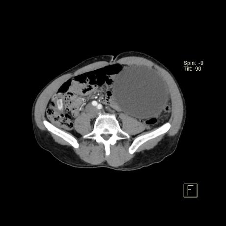 secuela común de la pancreatitis aguda