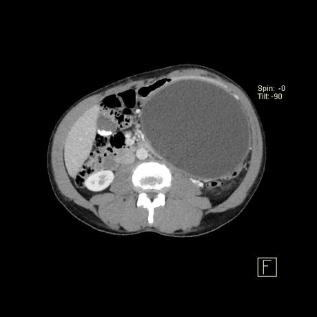 secuela común de la pancreatitis aguda
