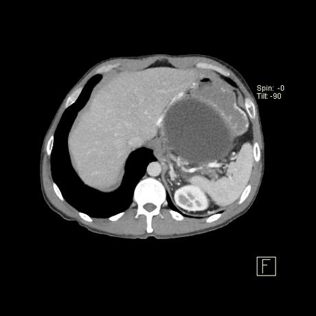 secuela común de la pancreatitis aguda