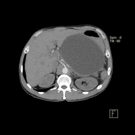 secuela común de la pancreatitis aguda secuela común de la pancreatitis aguda