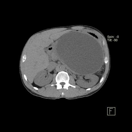 secuela común de la pancreatitis aguda