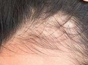Mejores Ampollas Anticaida Pelo