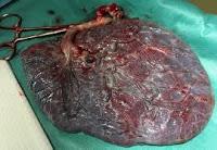 ¿Porque El COVID-19 no afecta o afecta poco a los fetos en Útero?