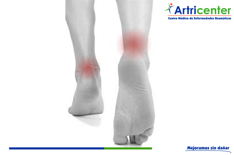 Bursitis Aquiliana, una causa de dolor en el pie.