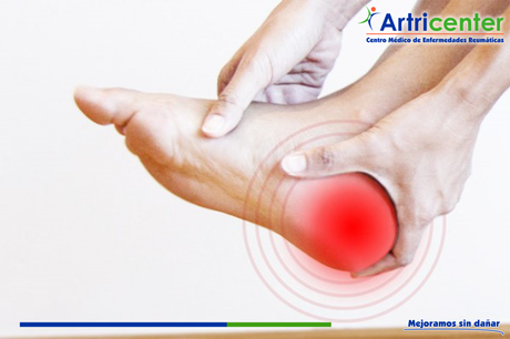 ¿Pueden las enfermedades reumáticas ocasionar compresión nerviosa en el pie?