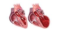 Uso del Ácido Retinoico para Tratar la Miocardiopatía Dilatada