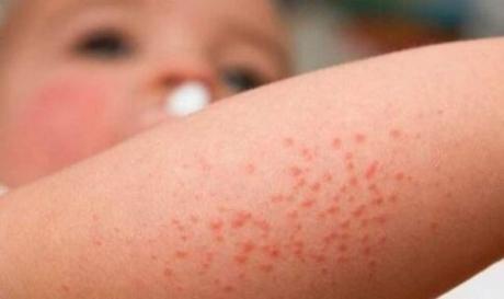 Con el frío llegan las afecciones de la piel como la dermatitis