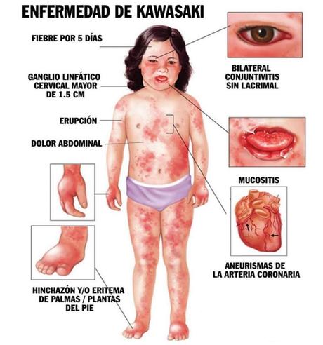 Enfermedad de Kawasaki