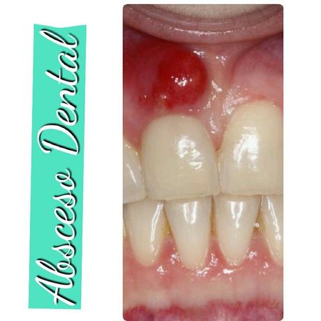 Efectos de la Quimioterapia en nuestra Cavidad Bucal