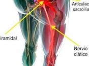 Remedios para dolor nervio ciático