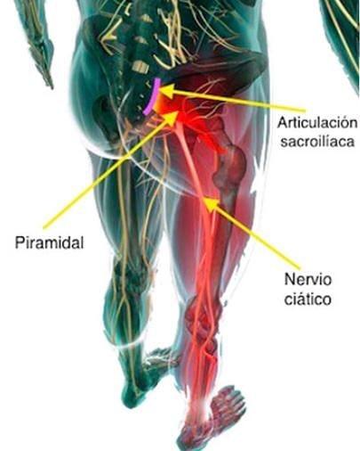 dolor del nervio ciático